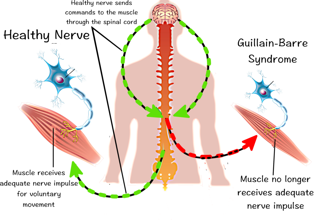 exercise-and-guillain-barre-syndrome-orlando-neuro-therapy